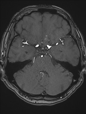 Cerebral arteriovenous malformation (Radiopaedia 84015-99245 Axial TOF 90).jpg