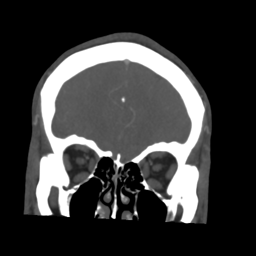 Cerebral arteriovenous malformation (Spetzler-Martin grade 2) (Radiopaedia 41262-44076 F 14).png