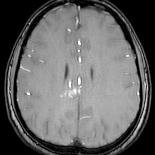 Cerebral arteriovenous malformation at posterior body of corpus callosum (Radiopaedia 74111-84925 Axial MRA 146).jpg