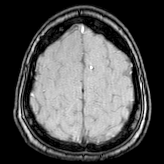 Cerebral arteriovenous malformation at posterior body of corpus callosum (Radiopaedia 74111-84925 Axial MRA 190).jpg