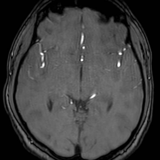 Cerebral arteriovenous malformation at posterior body of corpus callosum (Radiopaedia 74111-84925 Axial MRA 96).jpg