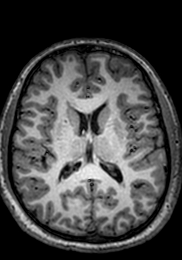 Cerebral arteriovenous malformation at posterior body of corpus callosum (Radiopaedia 74111-84925 Axial T1 124).jpg
