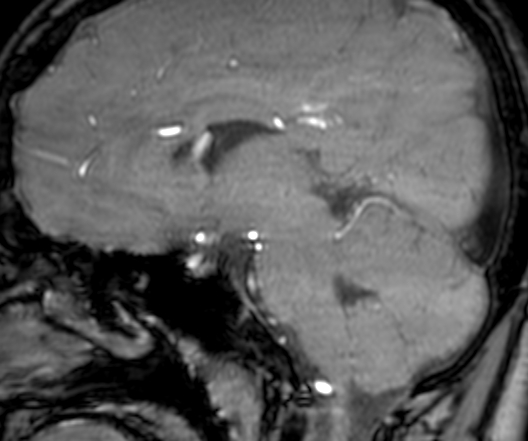 Cerebral arteriovenous malformation at posterior body of corpus callosum (Radiopaedia 74111-84925 J 179).jpg