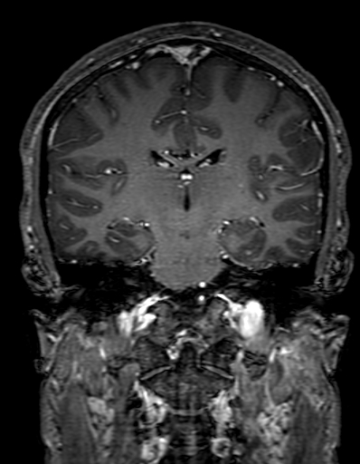 Cerebral arteriovenous malformation at posterior body of corpus callosum (Radiopaedia 74111-84925 K 204).jpg