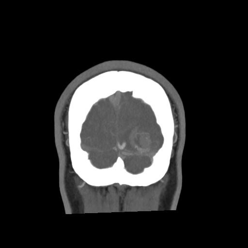 Cerebral arteriovenous malformation with lobar hemorrhage (Radiopaedia 35598-57216 C 87).jpg