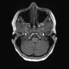 Cerebral cavernous venous malformation (Radiopaedia 70008-80021 Axial T1 9).jpg