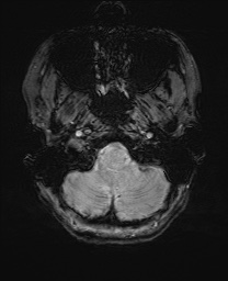 Cerebral cavernous venous malformation (Radiopaedia 70008-80021 I 7).jpg