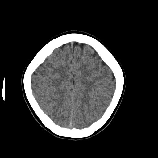 Cerebral cavernous venous malformation (Radiopaedia 70008-80022 Axial non-contrast 42).jpg