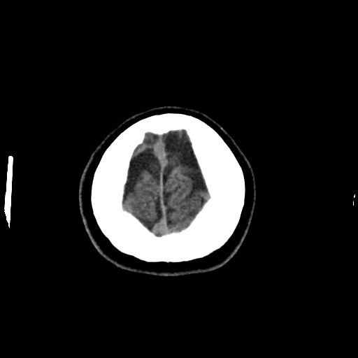 Cerebral cavernous venous malformation (Radiopaedia 70008-80022 Axial non-contrast 52).jpg