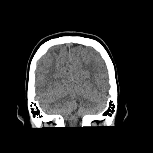 Cerebral cavernous venous malformation (Radiopaedia 70008-80022 non-contrast 54).jpg