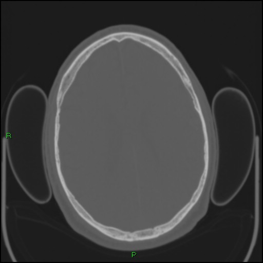 Cerebral contusions (Radiopaedia 33868-35039 Axial bone window 140).jpg