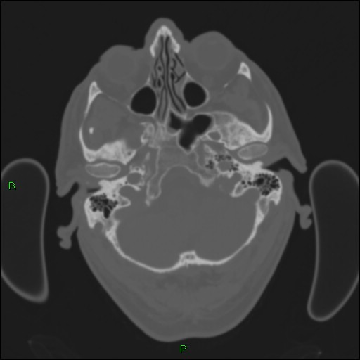 File:Cerebral contusions (Radiopaedia 33868-35039 Axial bone window 29).jpg