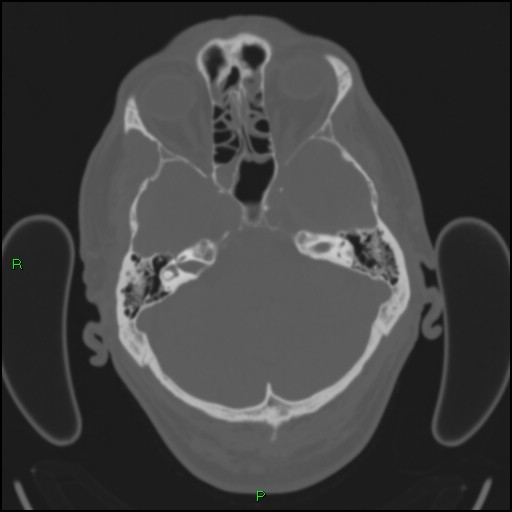 Cerebral contusions (Radiopaedia 33868-35039 Axial bone window 49).jpg