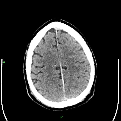 File:Cerebral contusions (Radiopaedia 33868-35039 Axial non-contrast 166).jpg