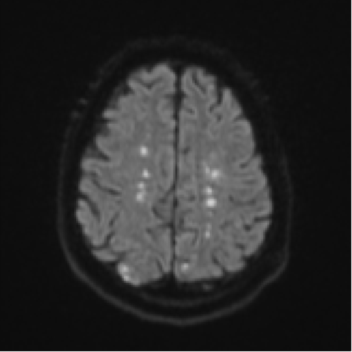 Cerebral embolic infarcts (embolic shower) (Radiopaedia 57395-64342 Axial DWI 63).png