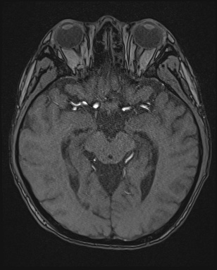Cerebral embolic infarcts (embolic shower) (Radiopaedia 72391-82921 Axial MRA 69).jpg