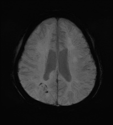 Cerebral embolic infarcts (embolic shower) (Radiopaedia 72391-82921 Axial SWI 49).jpg