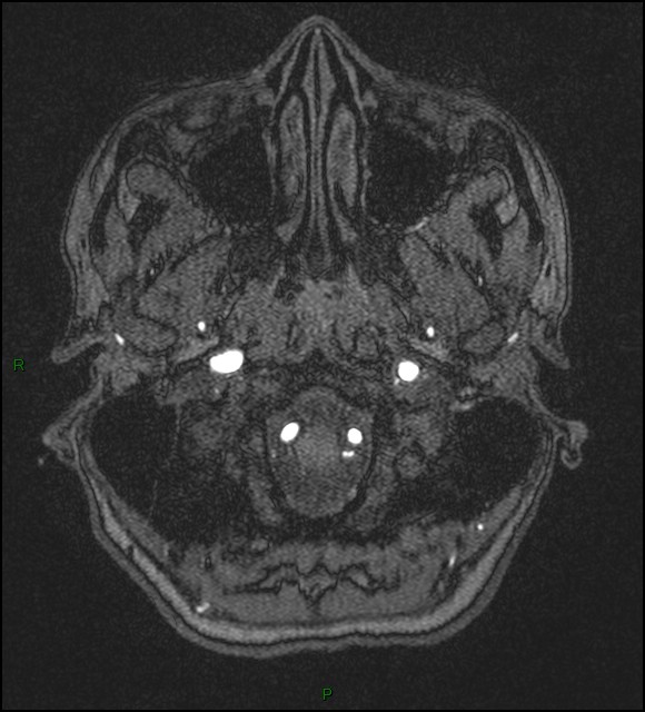 Cerebral fat embolism (Radiopaedia 35022-36525 Axial TOF 10).jpg