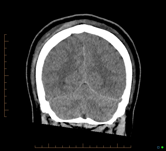 Cerebral fat embolism (Radiopaedia 85521-101224 Coronal non-contrast 48).jpg