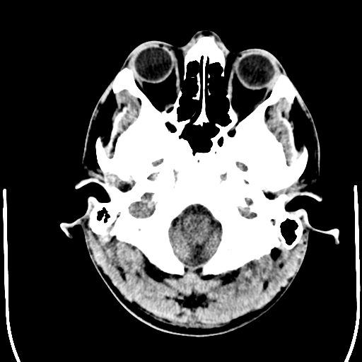 File:Cerebral hemorrhagic contusions- temporal evolution (Radiopaedia 40224-42754 Axial non-contrast 2).png