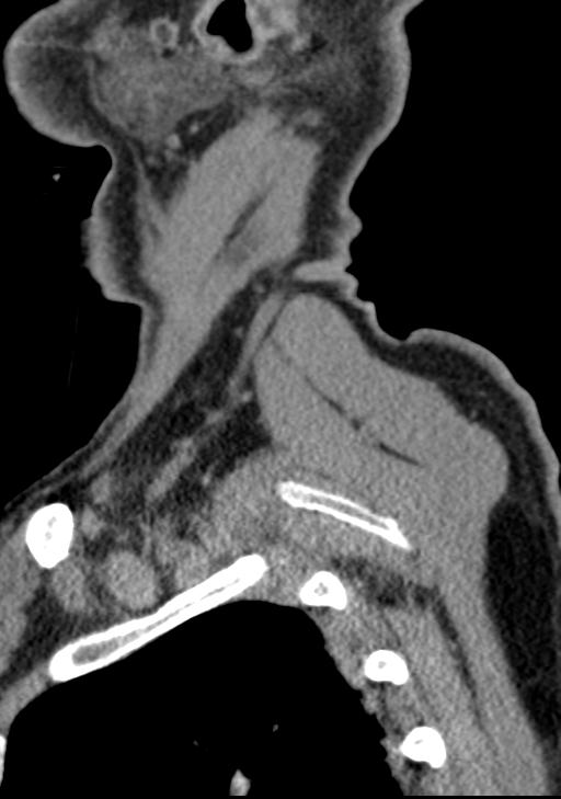 Cerebral hemorrhagic contusions and cervical spine fractures (Radiopaedia 32865-33841 G 12).jpg