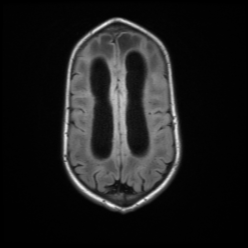 File:Cerebral manifestations of mucopolysaccharidosis type I (Radiopaedia 59171-66487 C 16).jpg