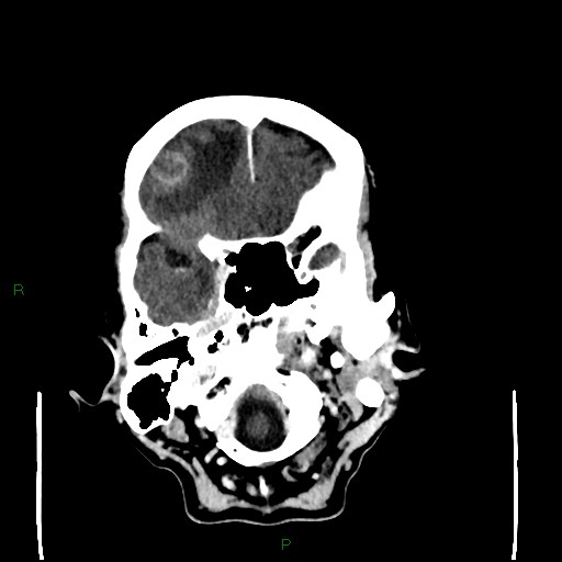 Cerebral metastases - breast primary (Radiopaedia 77653-89857 Axial C+ delayed 23).jpg
