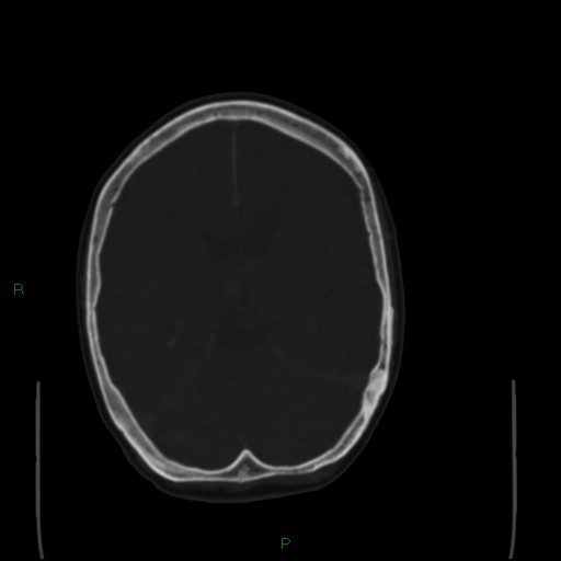 Cerebral metastases - breast primary (Radiopaedia 77653-89857 Axial bone window 62).jpg