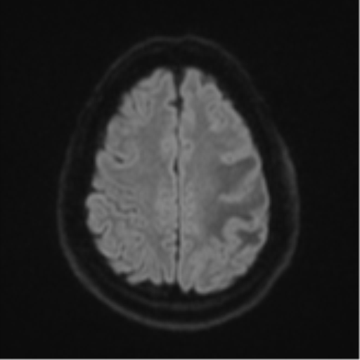 File:Cerebral metastases mimicking multifocal glioblastoma (Radiopaedia 50843-56353 Axial DWI 48).png