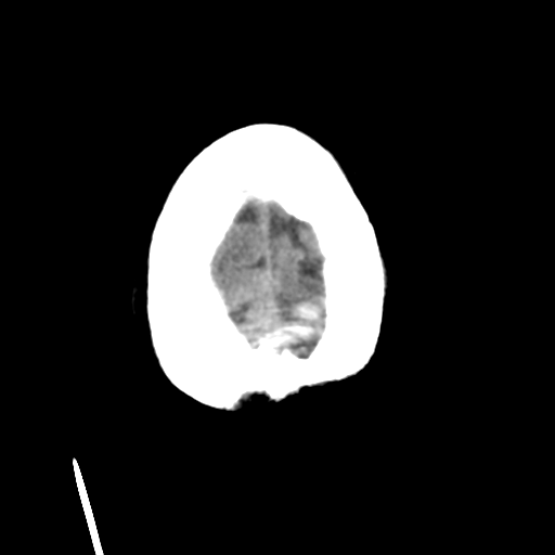Cerebral metastasis to basal ganglia (Radiopaedia 81568-95412 Axial non-contrast 55).png