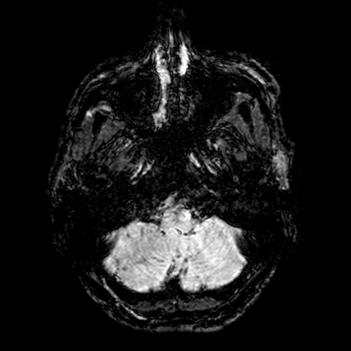 Cerebral parenchymal arteriovenous malformation (Radiopaedia 27280-27456 Axial SWI 3).jpg