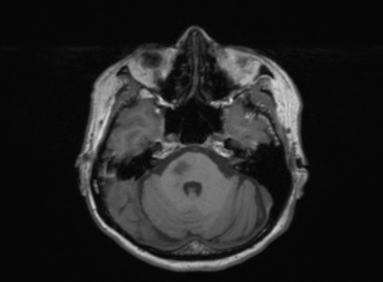 Cerebral ring enhancing lesions - cerebral metastases (Radiopaedia 44922-48817 Axial T1 294).jpg