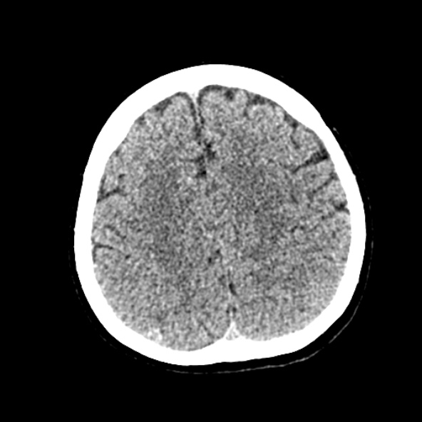 File:Cerebral ring enhancing lesions - cerebral metastases (Radiopaedia 44922-48818 Axial non-contrast 73).jpg