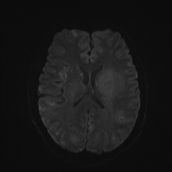 Cerebral toxoplasmosis (Radiopaedia 53993-60132 Axial DWI 43).jpg