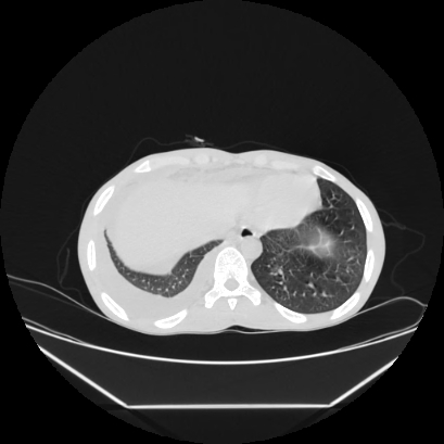 Cerebral tuberculoma (Radiopaedia 80829-94318 Axial lung window 154).jpg