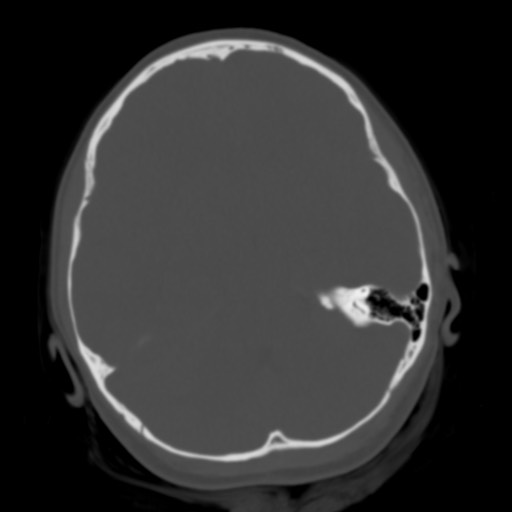 Cerebral tuberculosis with dural sinus invasion (Radiopaedia 60353-68018 Axial bone window 19).jpg