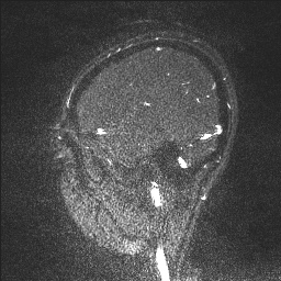 Cerebral tuberculosis with dural sinus invasion (Radiopaedia 60353-68090 Sagittal MRV 127).jpg