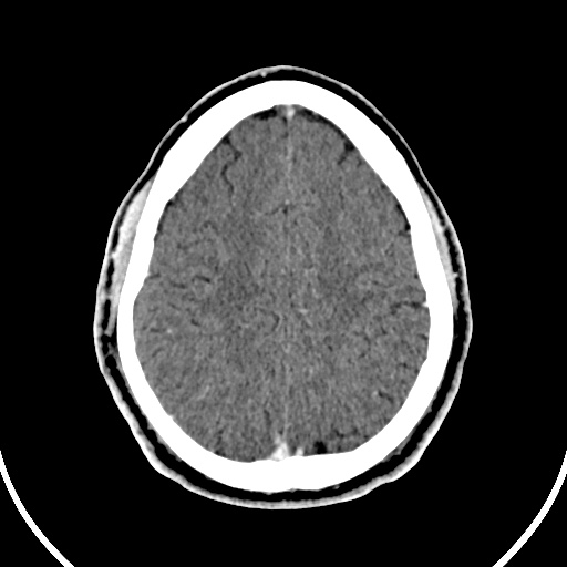 File:Cerebral venous angioma (Radiopaedia 69959-79977 B 78).jpg