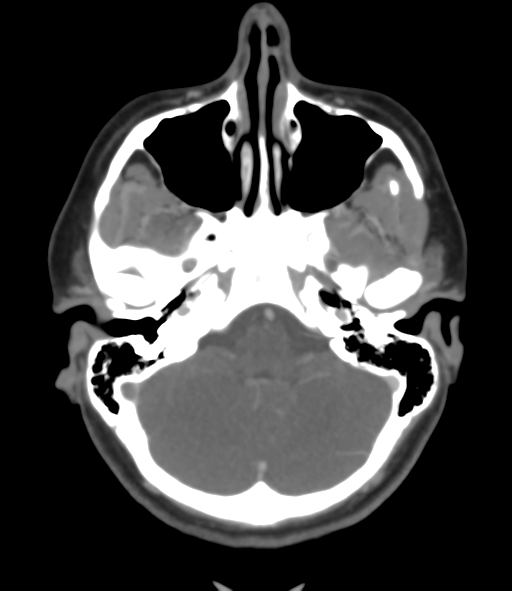 File:Cerebral venous hemorrhagic infarction (Radiopaedia 38461-40550 Axial MIP VENOGRAM 12).png