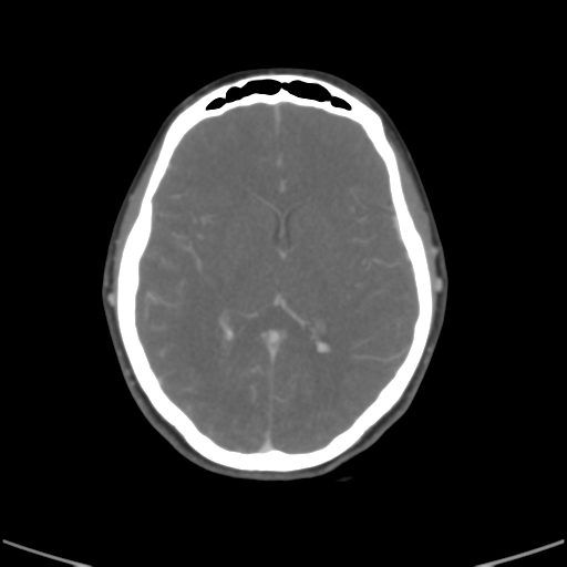 File:Cerebral venous hemorrhagic infarction (Radiopaedia 38461-40550 Coronal MIP VENOGRAM 1).png