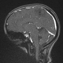 Cerebral venous infarction - hemorrhagic (Radiopaedia 81625-95505 Sagittal MRV 37).jpg
