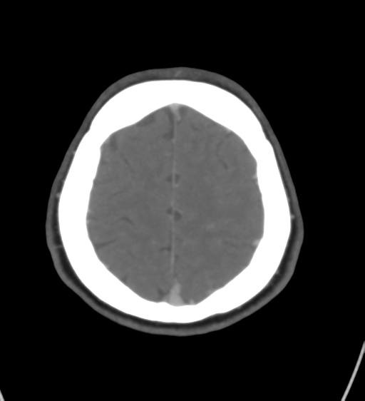 File:Cerebral venous infarction due to transverse sinus thrombosis (Radiopaedia 34688-36120 Axial CT venogram 42).png
