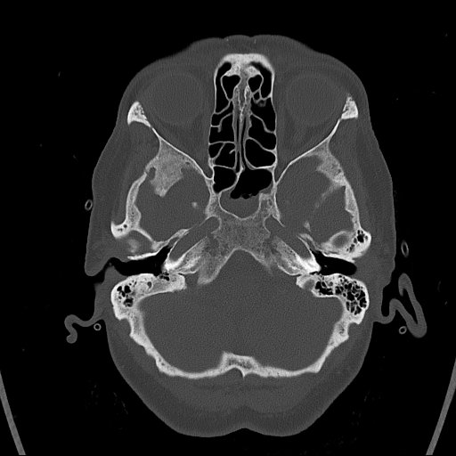 Cerebral venous infarction with hemorrhage (Radiopaedia 65343-74381 Axial bone window 20).jpg