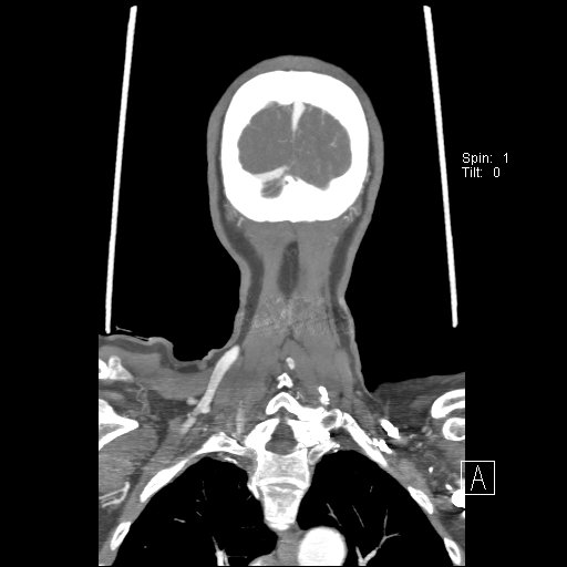 Cerebral venous infarction with hemorrhage (Radiopaedia 65343-74396 B 249).jpg