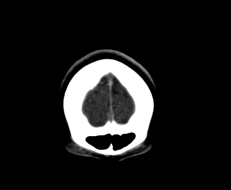 Cerebral venous sinus thrombosis (Radiopaedia 59224-66646 Coronal C+ delayed 1).jpg