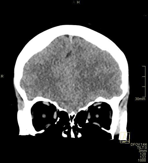 Cerebral venous sinus thrombosis (Radiopaedia 91329-108965 Coronal non-contrast 13).jpg