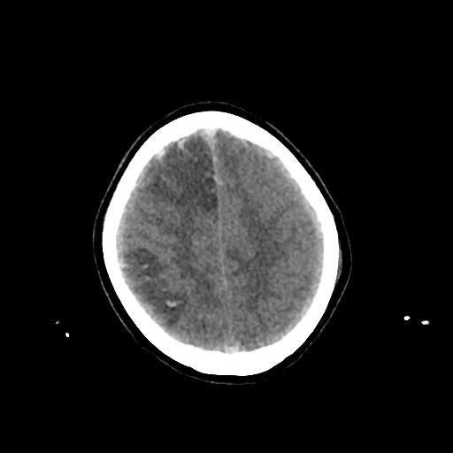 File:Cerebral venous throbmosis - hemorrhagic venous infarction (Radiopaedia 87318-103613 Axial non-contrast 137).jpg