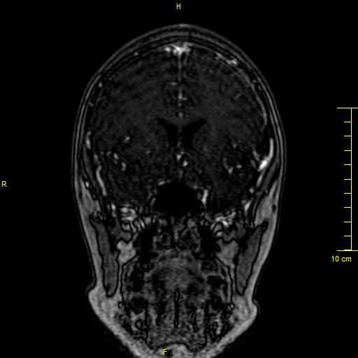 Cerebral venous thrombosis (Radiopaedia 23288-23351 MRV 38).JPG
