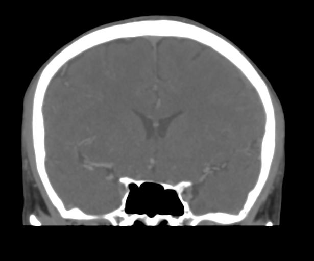 Cerebral venous thrombosis (Radiopaedia 38392-40467 Coronal CTA-Venogram 25).png