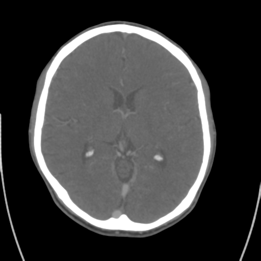 File:Cerebral venous thrombosis (Radiopaedia 38392-40467 D 1).png